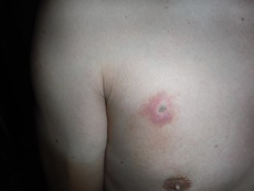 オオスズメバチに刺されてから二日後